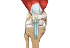 ACL Reconstruction Patellar Tendon