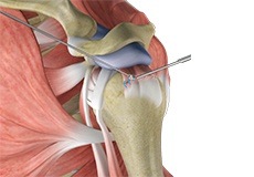 Arthroscopic Rotator Cuff Repair