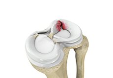 Meniscal Repair